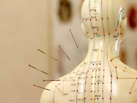 acupuncture