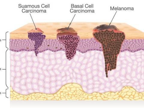 basal