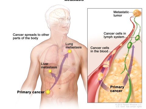 metastasis