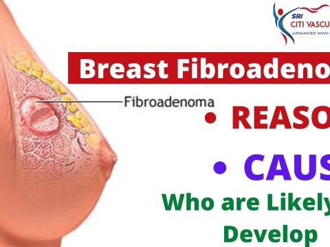 fibroadenoma