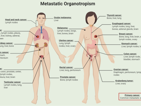 metastatic