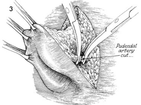 vulvectomy