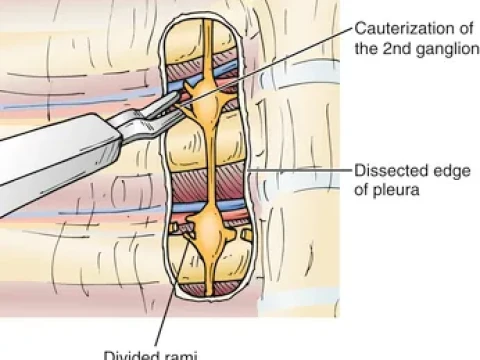 sympathectomy